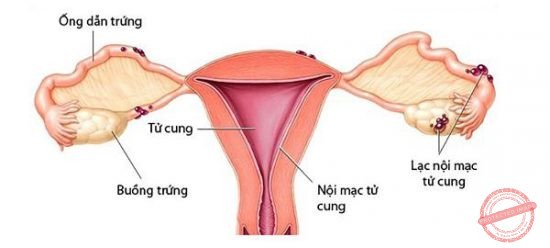 Hiện nay khoa học vẫn chưa tìm ra nguyên nhân chính xác gây nên lạc nội mạc tử cung.