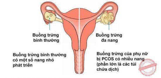 Sự khác biệt giữa buồng trứng bình thường và buồng trứng đa nang.