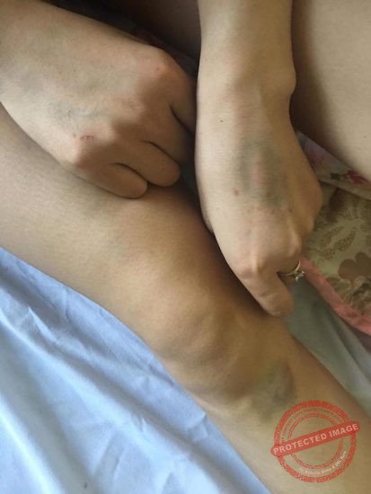 Vết bầm dập trên tay của chị K