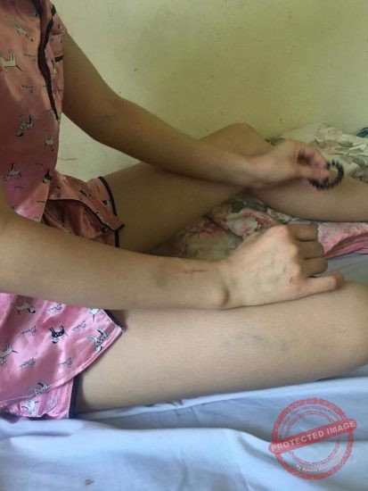 Tay chân đều có những vết bầm dập vì bị đánh