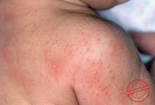 Cách trị rôm sảy cho bé trong những ngày hè nóng